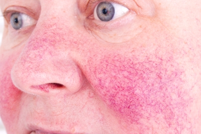 How To Treat Rosacea In These Modern Times