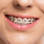 How Invisalign Technology Addresses Complex Bite Problems Often Overlooked by Traditional Braces