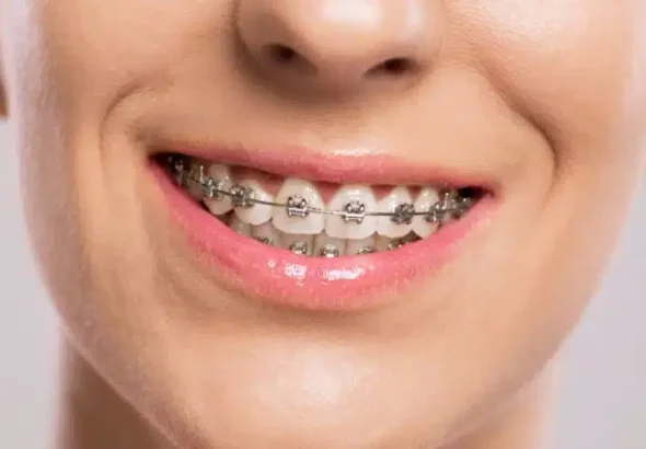 How Invisalign Technology Addresses Complex Bite Problems Often Overlooked by Traditional Braces