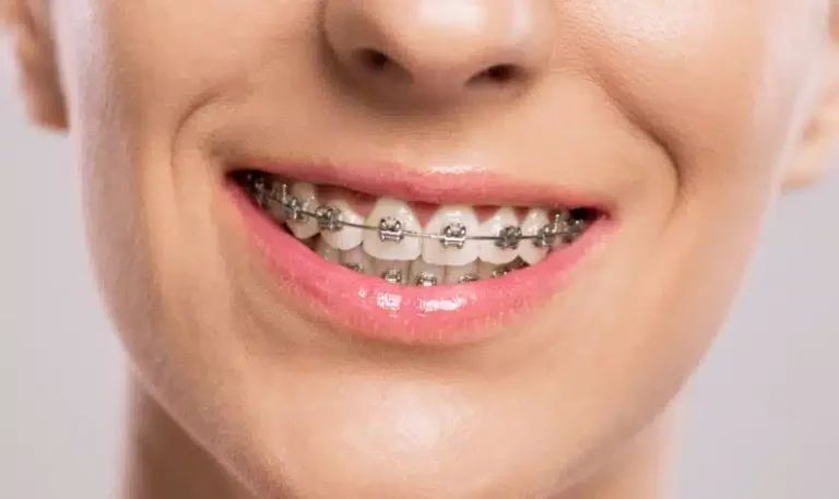 How Invisalign Technology Addresses Complex Bite Problems Often Overlooked by Traditional Braces
